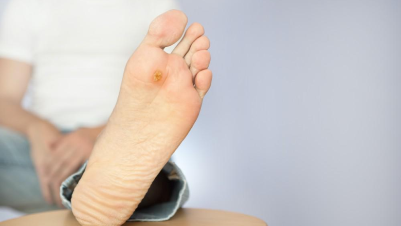 Do You Know What Role Foot Warts Play for Your Podiatric Health?