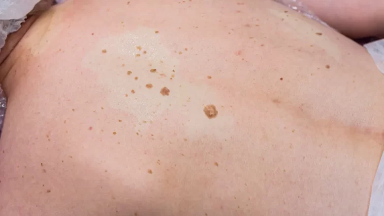 Why is skin cancer common among people? And how many types of cancer? 