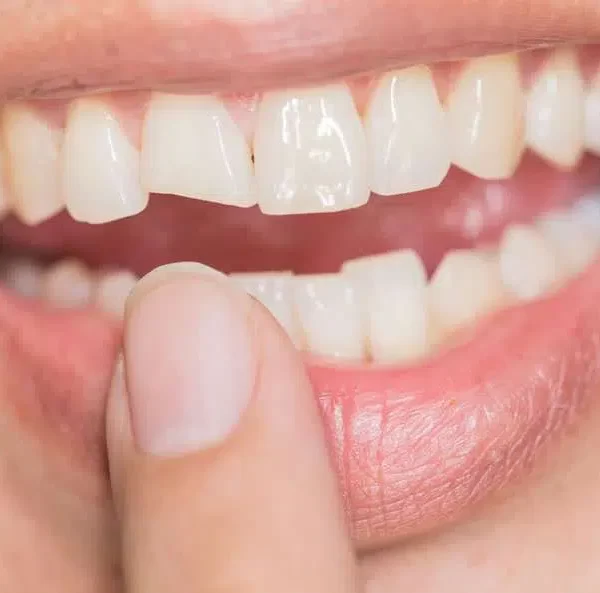When Should You Go to the Dentist for a Broken Tooth?