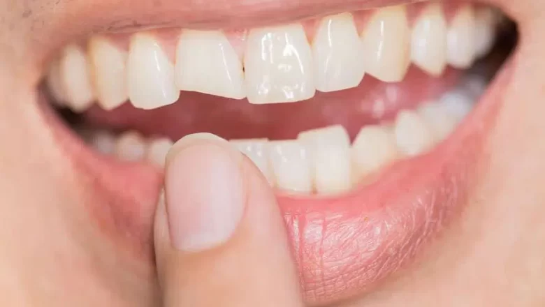 When Should You Go to the Dentist for a Broken Tooth?